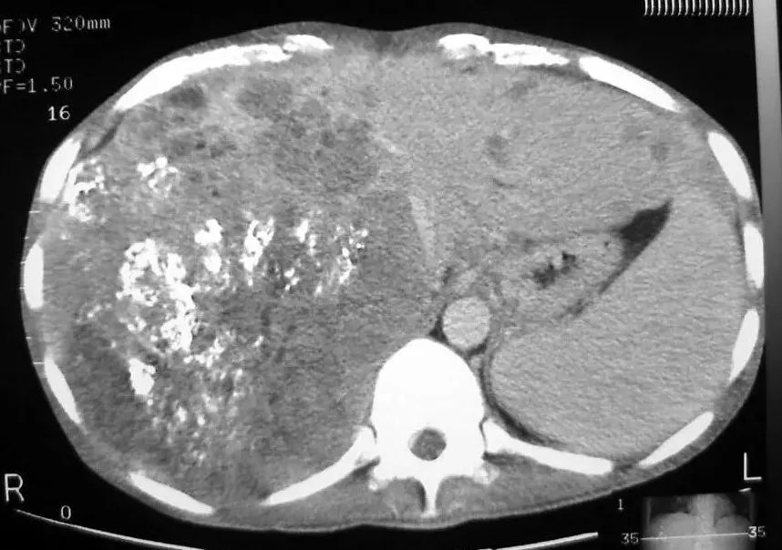 经常做介入对医生有影响吗,做了一次介入治疗不做了会怎样