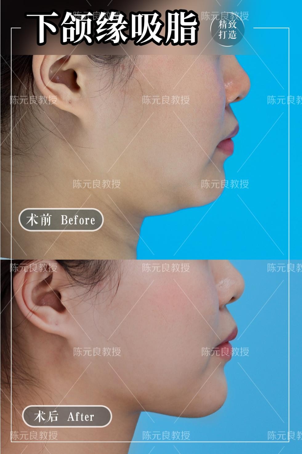 面部吸脂的真相,面部吸脂和双身体吸脂区别