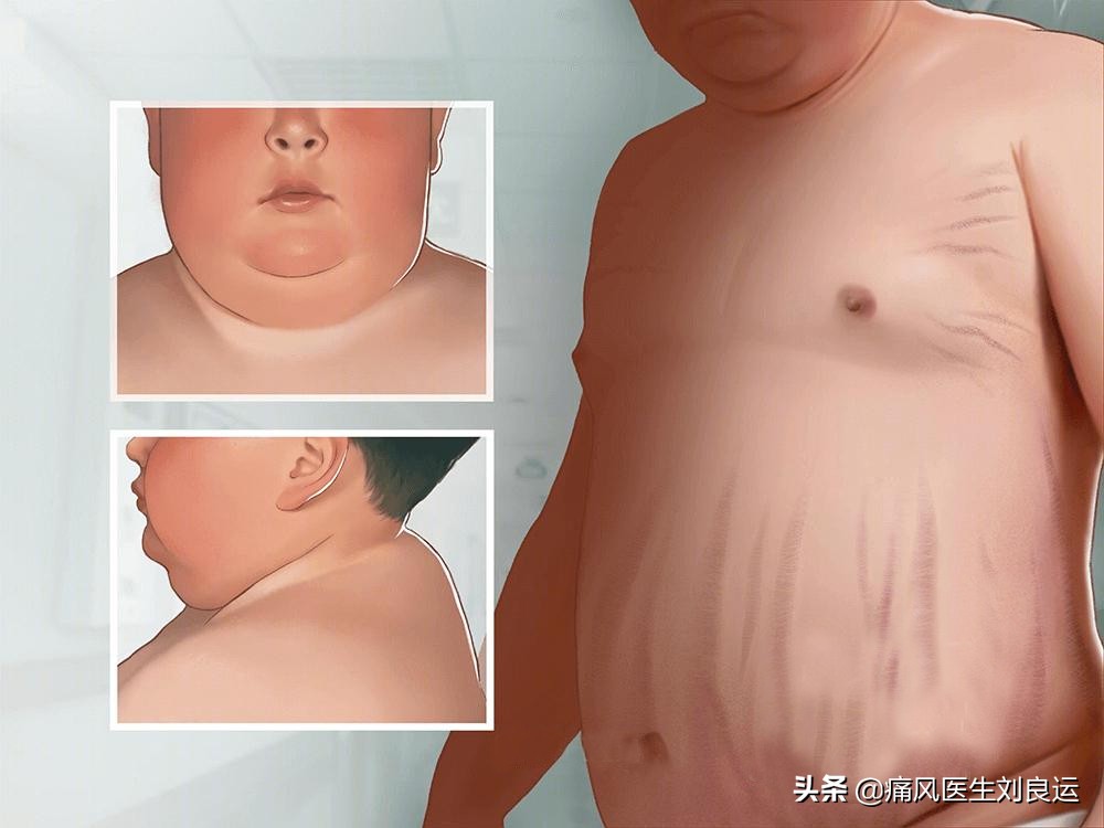 地塞米松可以治疗痛风发作吗,痛风打地塞米松的副作用