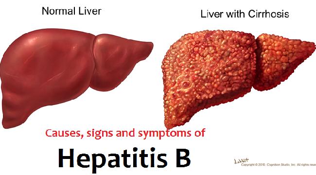 有肝掌蜘蛛痣得肝硬化的几率大吗,有肝掌和蜘蛛痣一定是肝硬化么