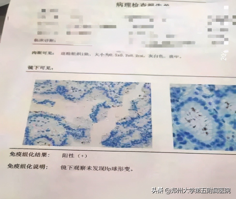 皮肤紫癜反反复复,全身多处皮肤瘀斑考虑什么疾病