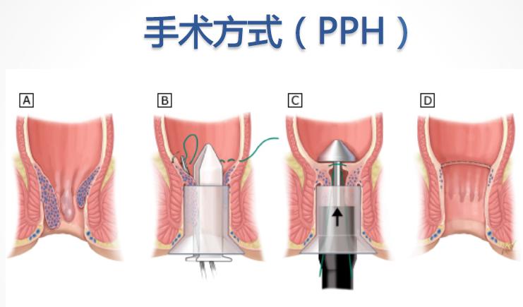 对于痔疮预防该从饮食开始,对痔疮最有效的治疗方法