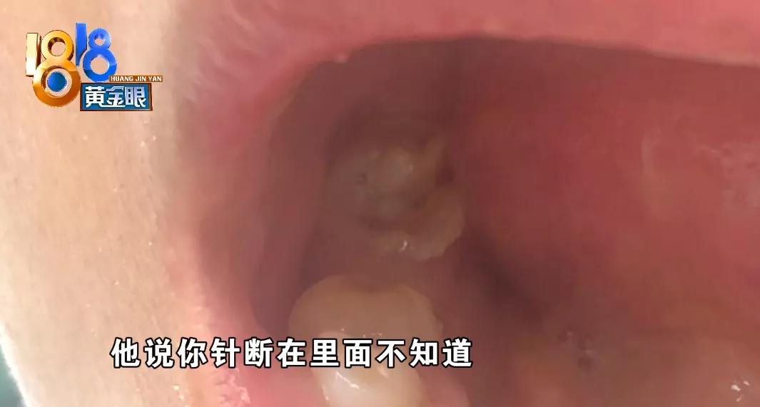 牙齿内有断针如何取出,断针在牙齿里医院要负责吗