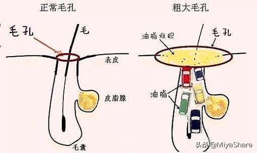 只需简单三步轻松解决长痘烦恼,青春期脸上长痘自卑怎么办