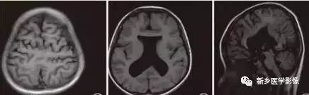 影像学脑室扩大,脑室显大怎么理解