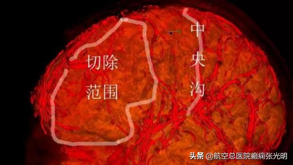 难治性癫痫治不好怎么办,难治性癫痫的诊断标准与治疗方法