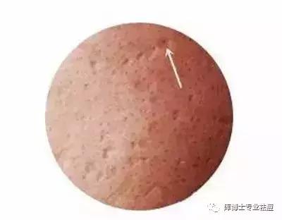 库博士祛痘怎么收费,库博士专业祛痘怎么样