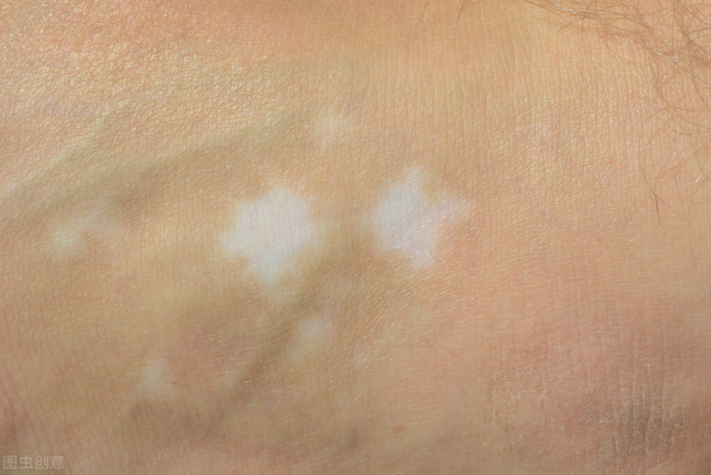 初期白癜风怎么治疗最好,初期白癜风该怎么治愈