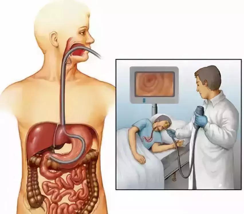 胶囊胃镜再也不用忍受插管的痛苦,插管胃镜和无痛胃镜哪种最好