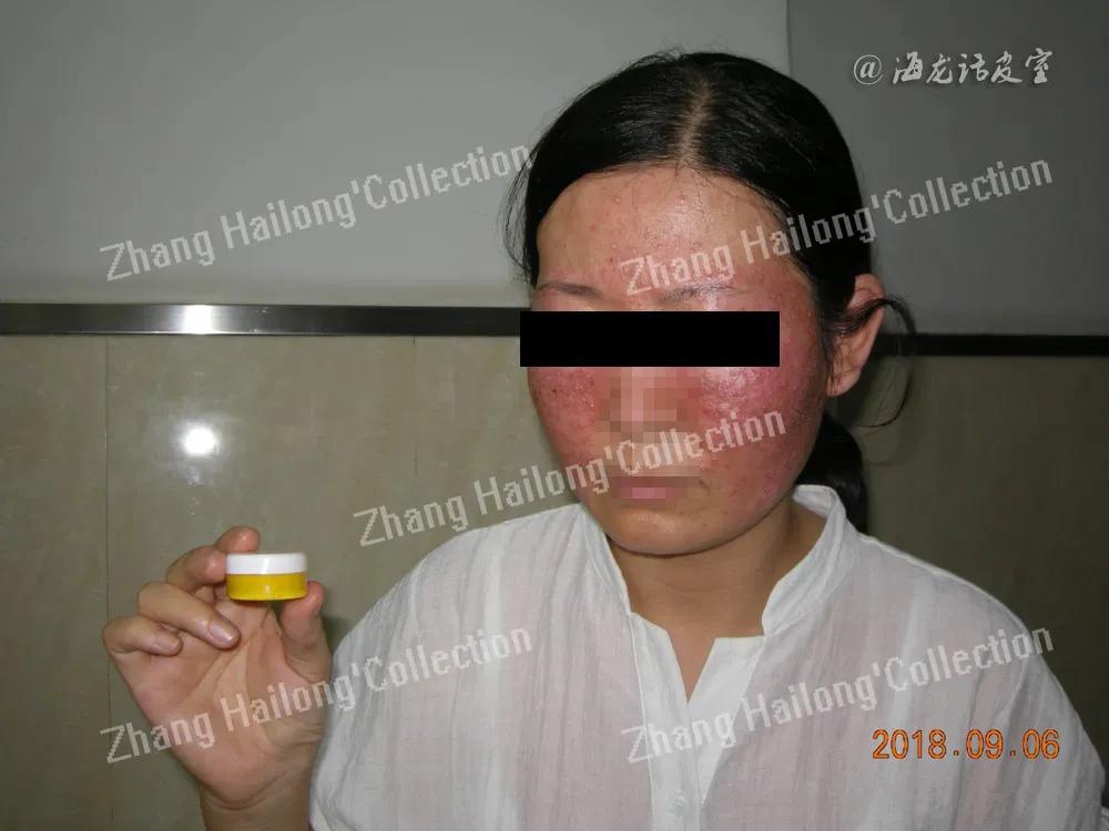 常见的脸部皮肤病有哪些,面部皮肤病辨别图解