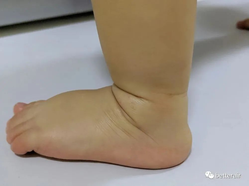 宝宝湿疹好了后一哭就变红,宝宝湿疹怕冷还是热