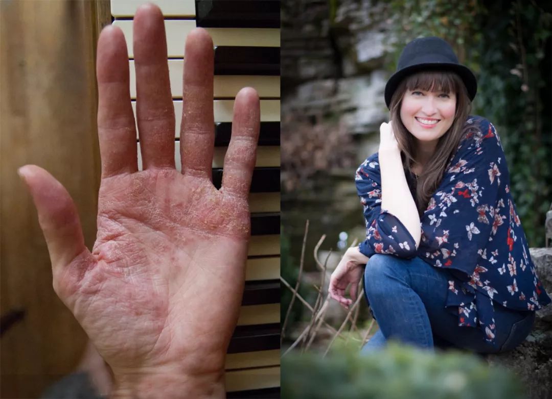 老是莫名其妙真菌感染,总是真菌感染是因为什么