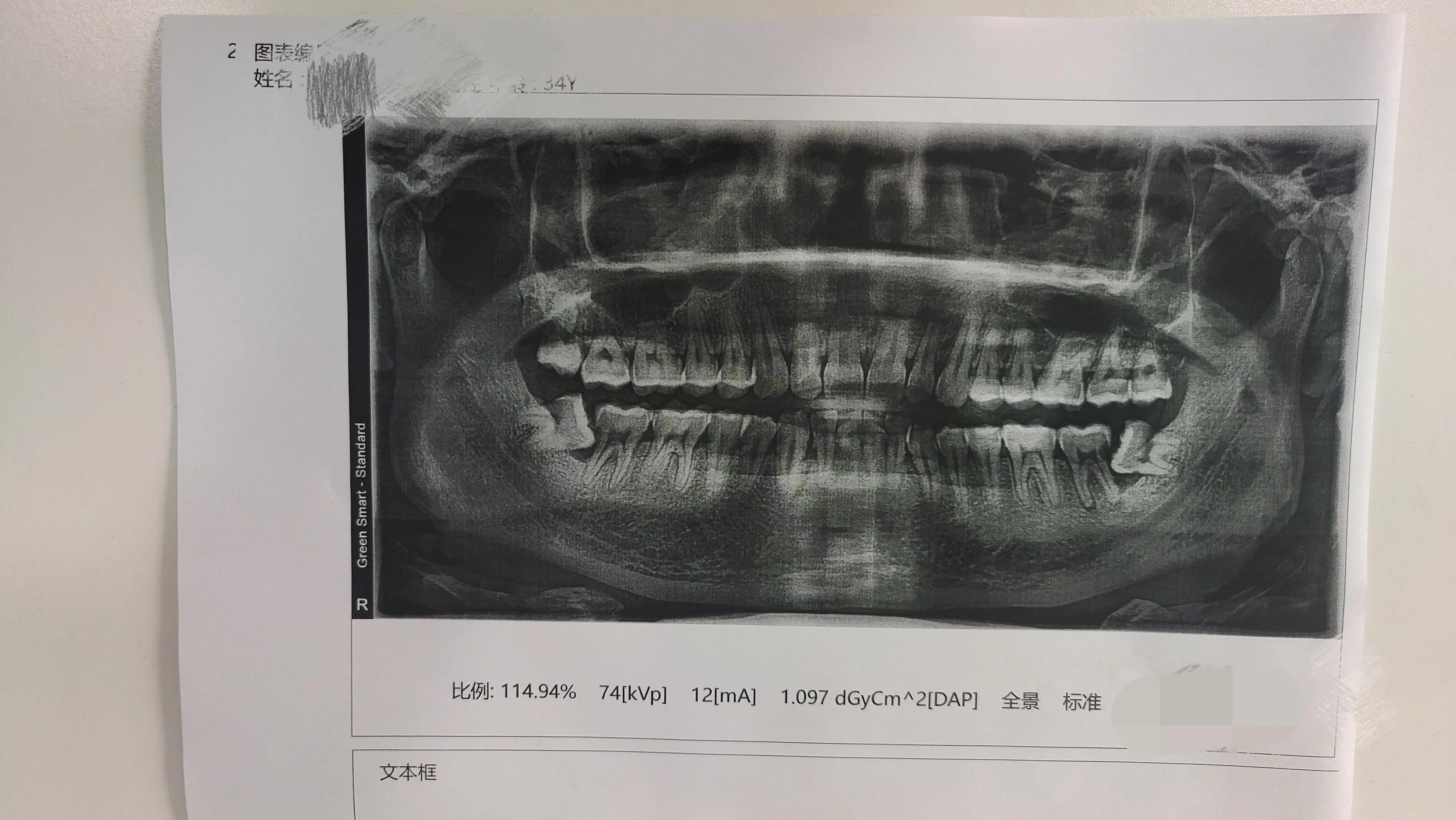 你是否有跟我一样的治疗牙齿经历？如果想找刺激，就去拔牙