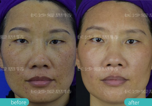 什么样的斑适合激光祛斑,青褐斑可以用激光吗