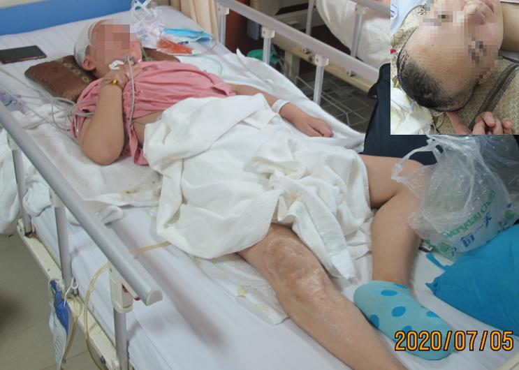 脑室有粘连脑积水有什么办法,脑动脉畸形手术后出现急性脑积水