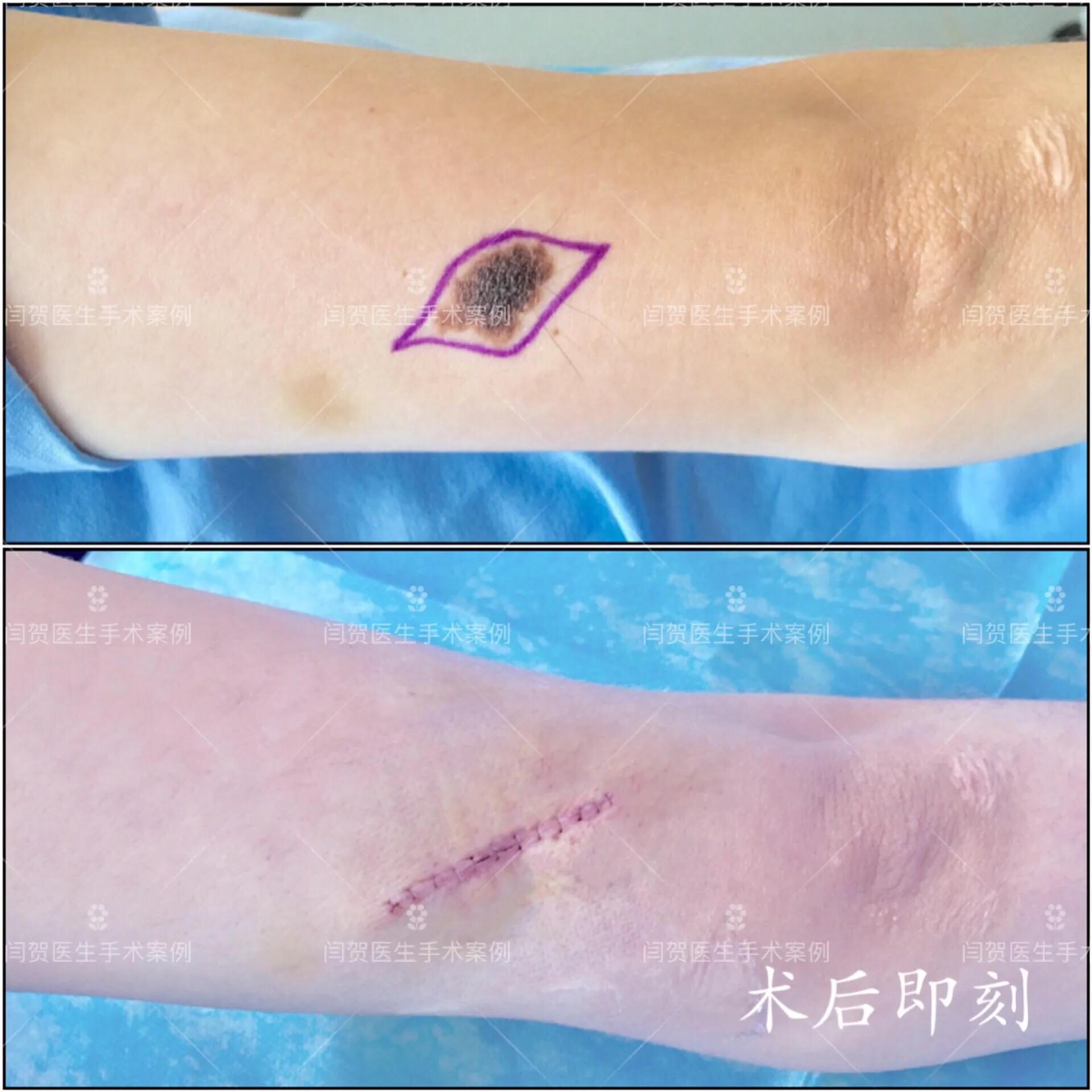 脚底有痣激光还是手术切除,黑色素痣手术切除还是激光去除好