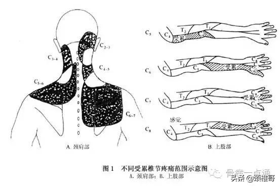 神经根型颈椎病，仅1%的患者需要手术，确定不是你？