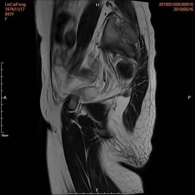 子宫腺肌症「不死的癌症」——介入栓塞来帮忙