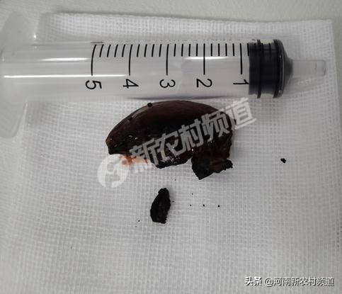 72岁老人误吞枣核后续,81岁老人误吞杏核