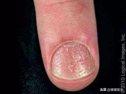 指甲有白点肚子里有蛔虫？月牙越大越健康？指甲软是缺钙……