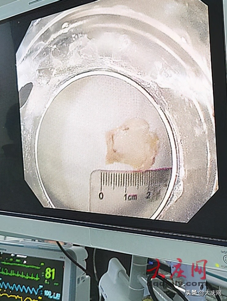 女子鱼骨卡喉,鱼刺卡住做喉镜取出全过程