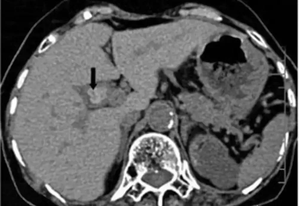 什么情况下有息肉会癌变,哪些部位长息肉最严重