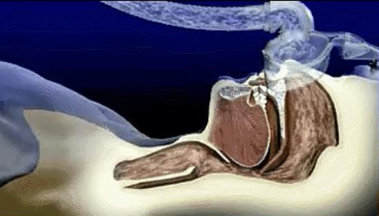 瑞迈特单水平呼吸机,单水平呼吸机的作用