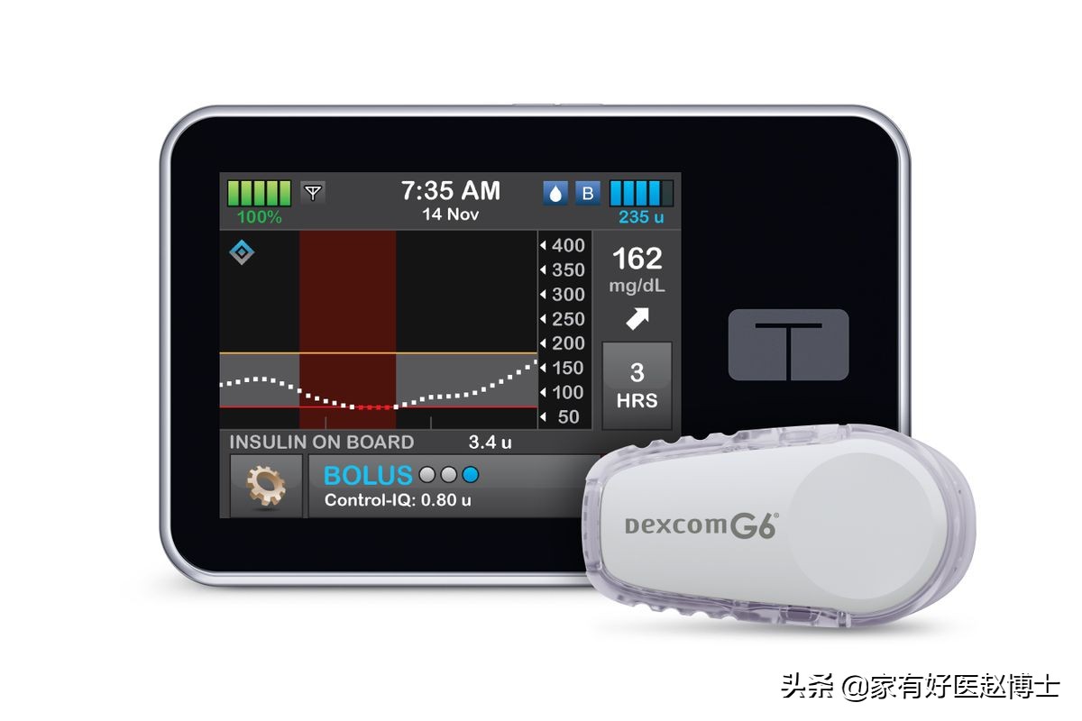 有没有人工智能胰岛素泵,人工胰岛素泵