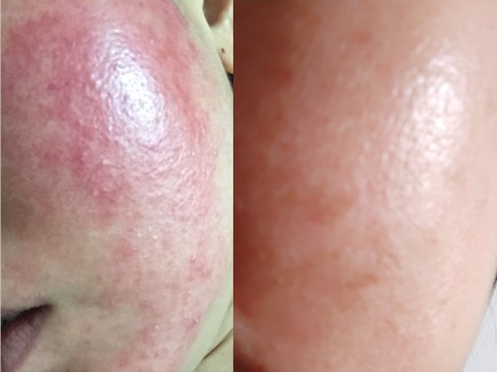 17岁的孩子身上脸上长了好多痘痘,17岁女孩脸上长好多痘痘怎么办