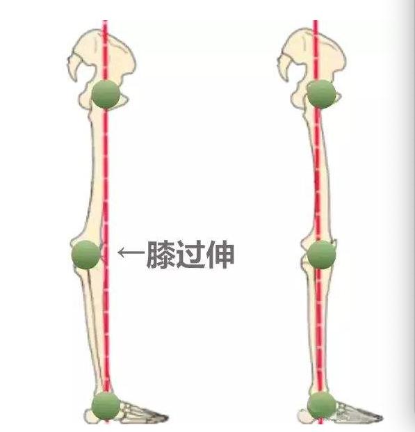 脑梗膝过伸能自动恢复吗,脑梗膝过伸是什么意思