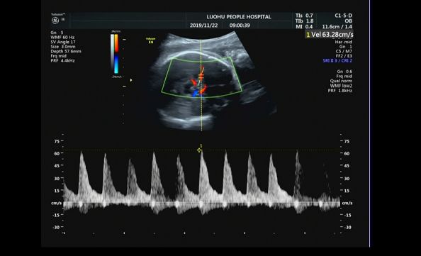 腹中胎儿水肿还能要吗,胎儿rh溶血症的解决方法