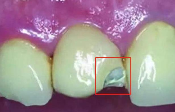 烤瓷牙崩瓷修复的详细步骤,烤瓷牙崩瓷必须更换吗