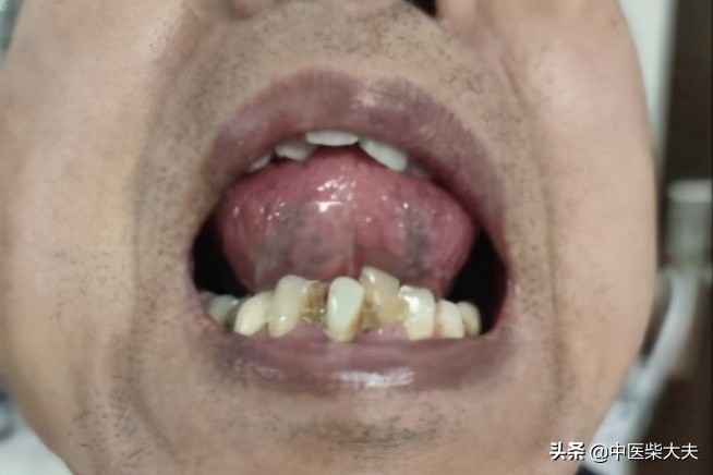 散偏汤实例——困扰20年的头痛，散偏汤加减5付见效