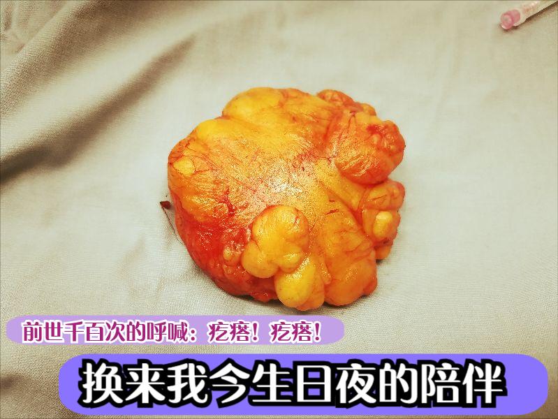 脂肪瘤的案例,脂肪瘤的产生机理