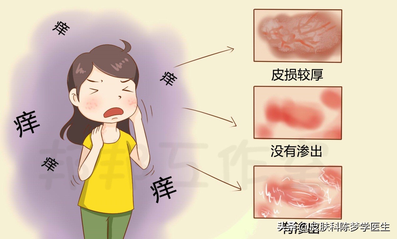 不同分期的湿疹怎么治疗,湿疹痒得钻心怎么办