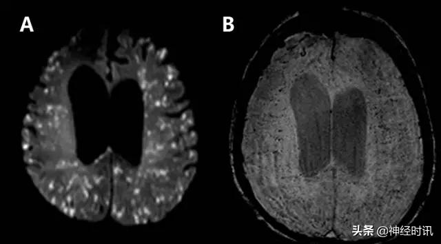 脑卒中病历诊断书图片,脑卒中影像判断技巧图解电子版