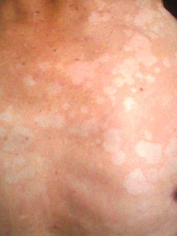 夏天到了身上流汗痒怎么解决,夏天到了总是大汗淋漓怎么缓解