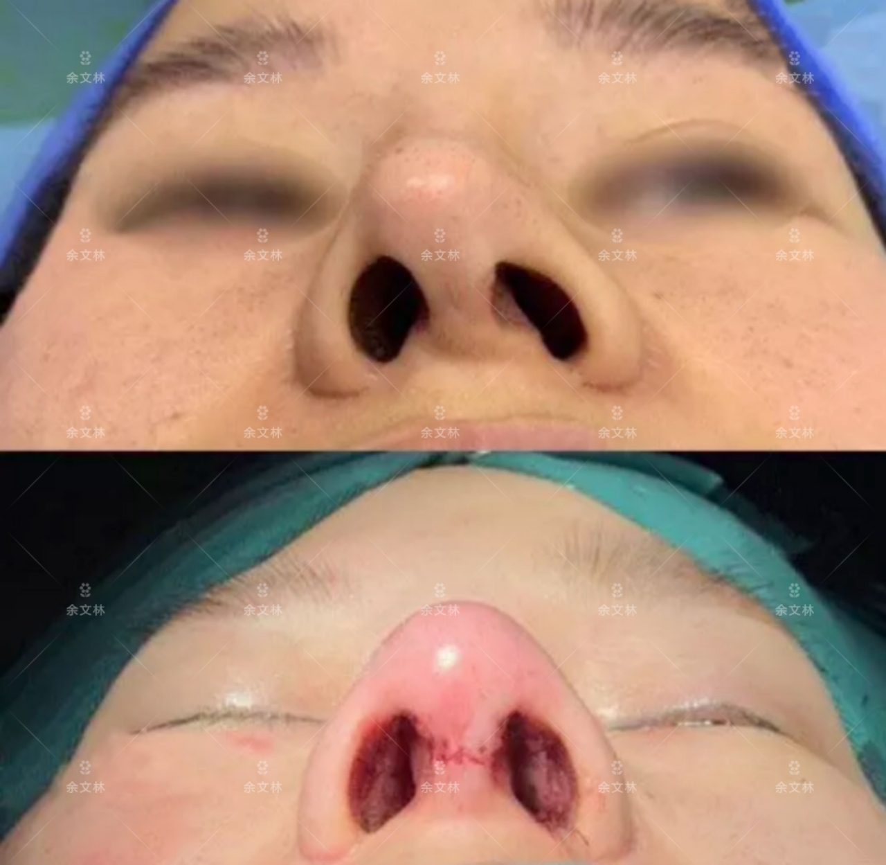 余文林鼻子矫正,余文林裂鼻整形手术