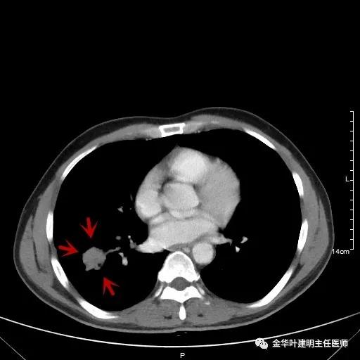 伴有脑转移了的肺癌能手术吗?