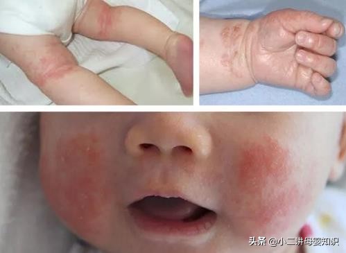 宝宝湿疹可以喝鸡鸭蛋膏吗,宝宝湿疹反复就是牛奶蛋白过敏吗