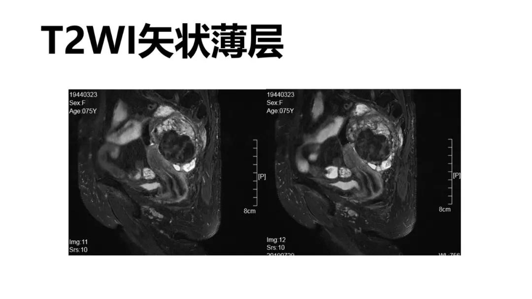 卵巢原发肿瘤的分析思路