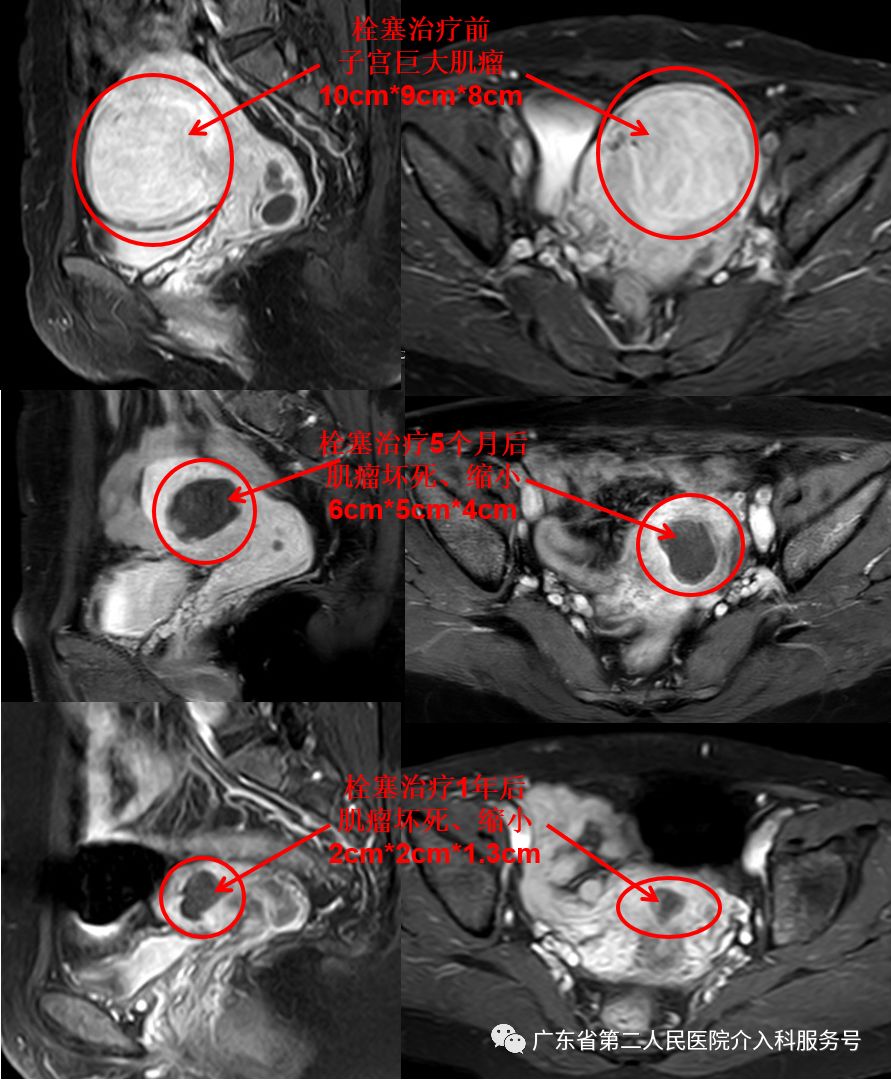 针眼妙方治疗，1个月后让淋沥不净的“大姨妈”如期结束