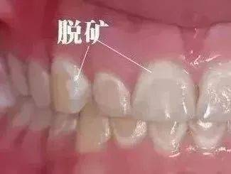 牙齿脱矿造成脱落需要补牙吗,宝宝脱矿的牙齿能恢复吗