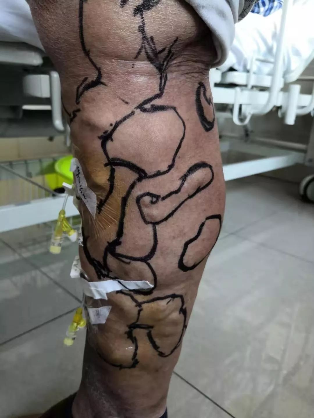 微创静脉曲张全国专家,治疗静脉曲张最新科技