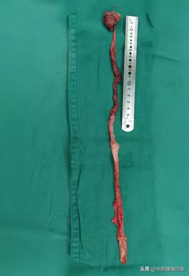 小孩怎么发现泌尿系统畸形,儿童肚子大鼓鼓的需要检查什么