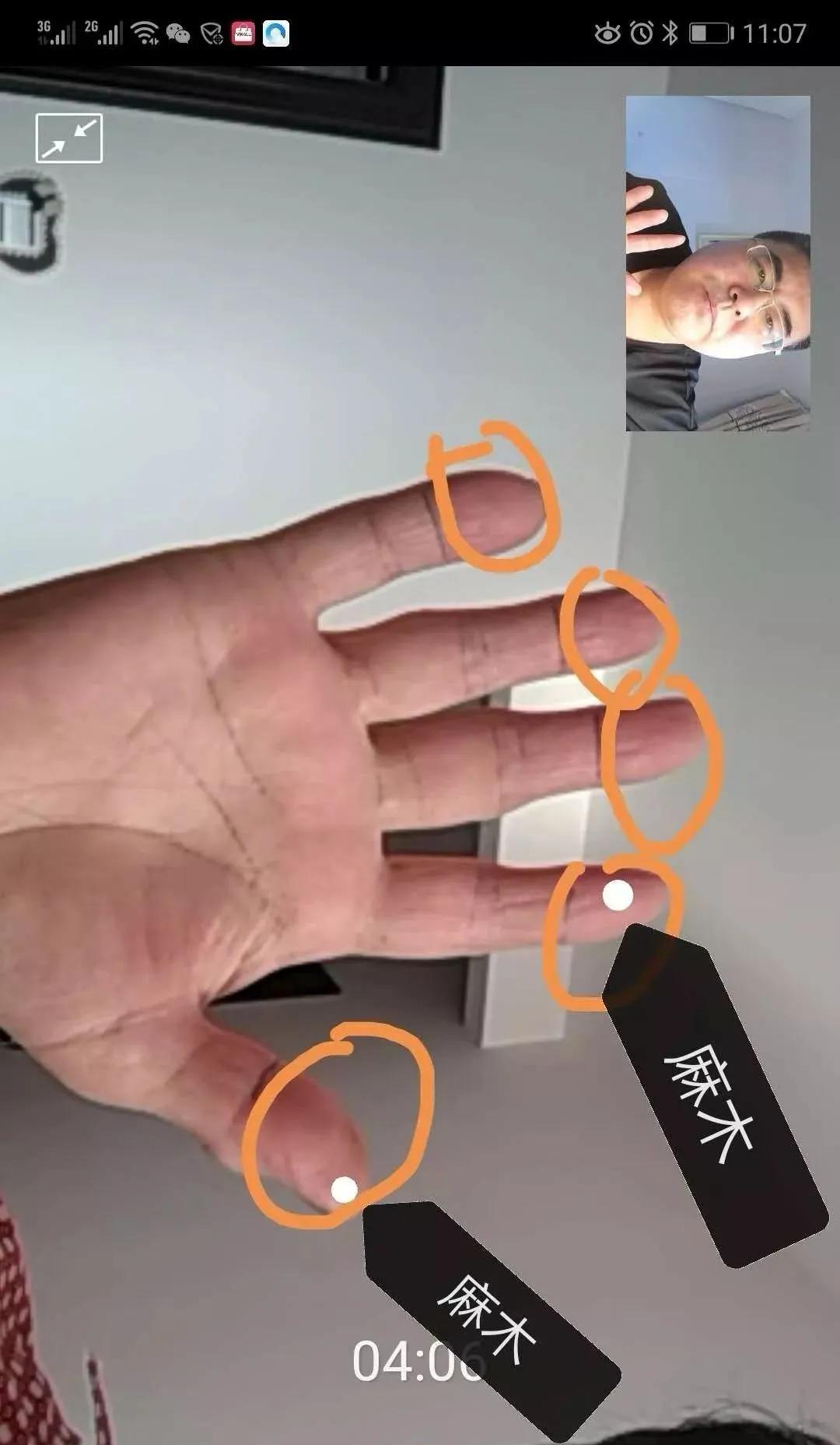 尺神经卡压自我恢复锻炼,枕大神经卡压自我恢复锻炼