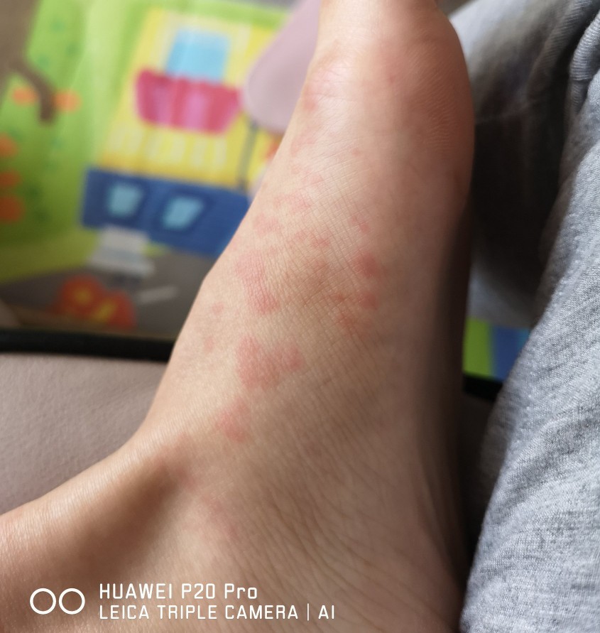 斯蒂尔综合症倪海厦,斯蒂尔综合症如何确诊