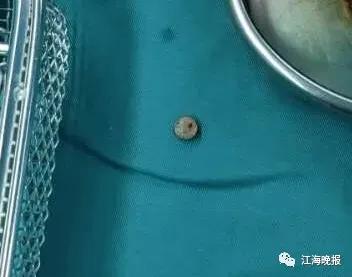 7岁小孩误吞纽扣电池,2岁女童误吞纽扣电池