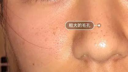 有黑头和没黑头有什么区别,没有长过黑头却长黑头怎么办