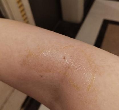 王大妈儿媳妇花了1W脱毛后才明白,千万不要轻易去脱毛